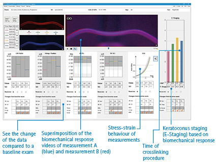 BEST Display - Homburg Biomechanical E-STaging Display: quantification of early biomechanical changes