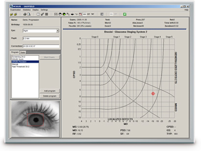 OCULUS perimetry software: Glaucoma Staging System (GSS 2) per Brusini